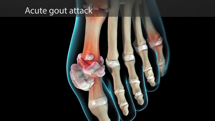 Dolor de juanetes o gota